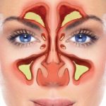 Tratamente naturiste pentru secretiile post nazale