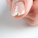 Caracteristici ale unghiilor care ofera indicii despre starea de sanatate