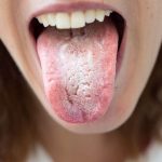Cum sa controlezi candidoza cu 6 remedii naturale